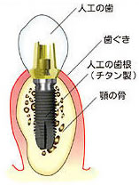 インプラント
