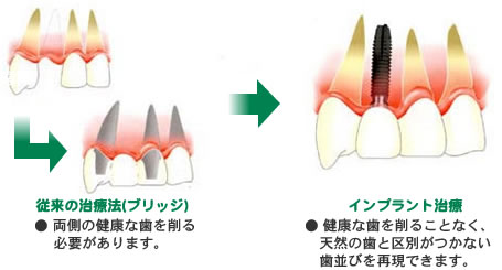 インプラント治療