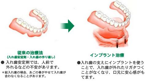 インプラント治療