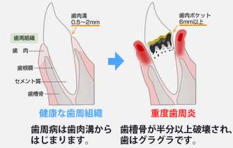 歯周病予防