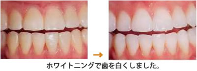 ホワイトニング