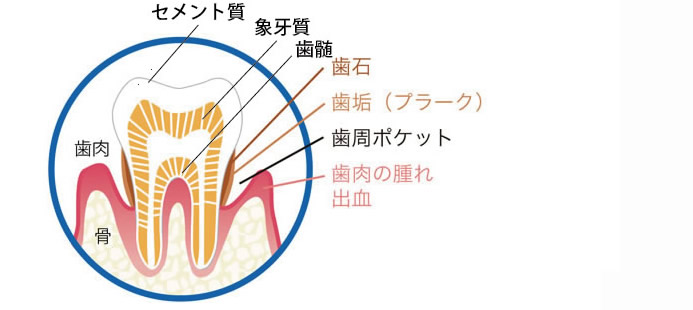 歯周病治療